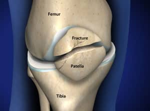 can you shatter your knee cap