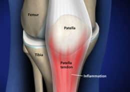 Patella tendon inflamation