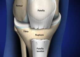 patella tendon rupture