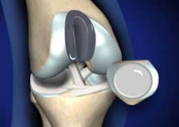 patellofemoral