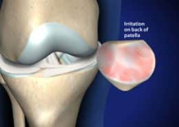 Irritation on back of patella