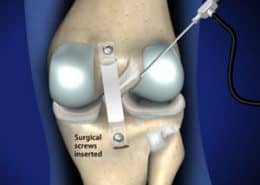 Surgical screws inserted