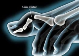 Hammertoe Correction space created