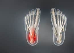 Plantar Fasciitis
