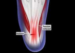 Incision - tension relieved