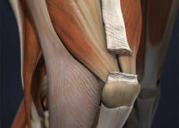 quad tendon rupture