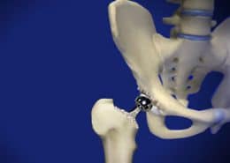 Revision Hip Surgery