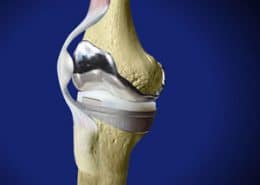 Revision knee surgery