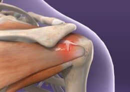 Rotator Cuff Injury