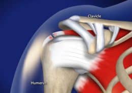 Rotator Cuff Tears