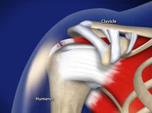 broken rotator cuff