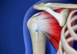 Mini-Open Rotator Cuff Repair