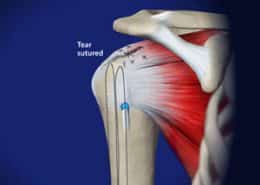 Rotator Cuff Tear sutured