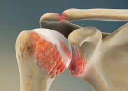 Osteoarthritis of the Shoulder