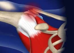 Shoulder Impingement Syndrome