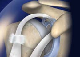 Slap tear