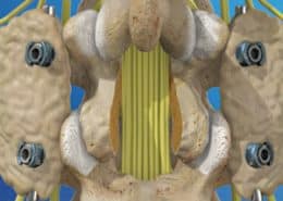 Spinal Fusion