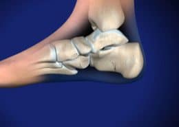 Stress Fractures