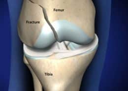 supracondylar femur fracture