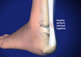Achilles Tendon healthy sections stitched together