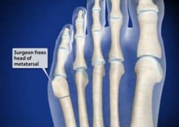 Surgeon frees head of metatarsal