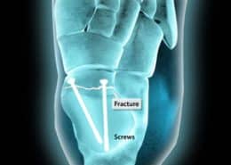 Talar Fracture - screws