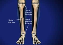 tibial fractures