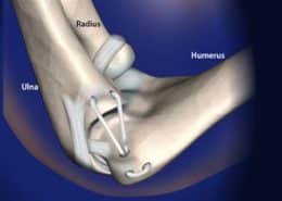 Tommy John Surgery