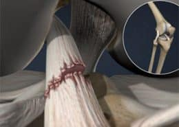 torn ACL