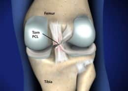 Torn PCL