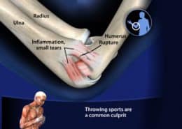 Humerus Rupture, inflammation, small tears
